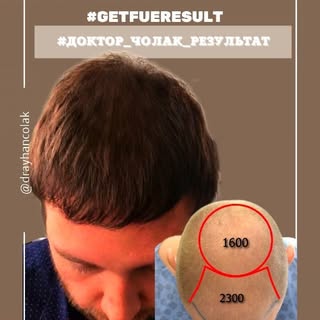 Brief epicrisis of this transplant ⤵️
❗Total volume 3850 grafts
❗ The maximum density is made in the