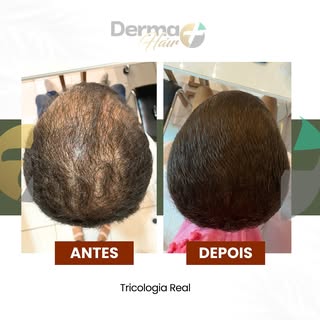 Vamos de resultados!
.
Paciente com AGA e no nosso tratamento intensivo já obtivemos ótimos resultad