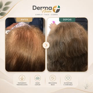 Resultados que impressionam! 💫 Este é o poder do nosso tratamento para queda de cabelo. Cada fio co