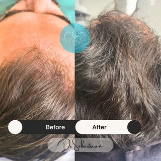 Absolutely love seeing the results after a 3 month follow up with our incredible rigenera treatment.