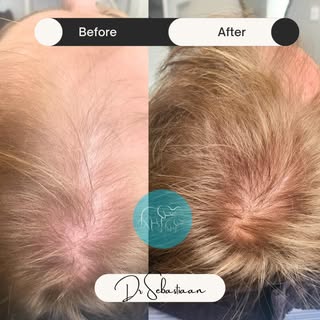 Fantastic results 3 months after treatment for this gentleman! We couldn't be more excited to see hi