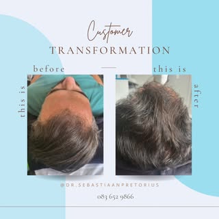 Transformation Tuesday ✨

Hair restoration ➡️ 3 month post session
Dr Sebastiaan Pretorius 
083 652 