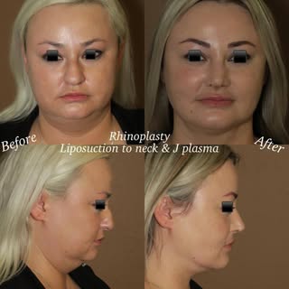 Amazing combination surgery of rhinoplasty and liposuction of the neck with skin tightening J plasma