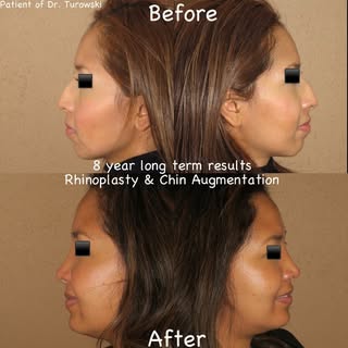 Ever wonder what you would look like years after your rhinoplasty and chin surgery?! Here is a great