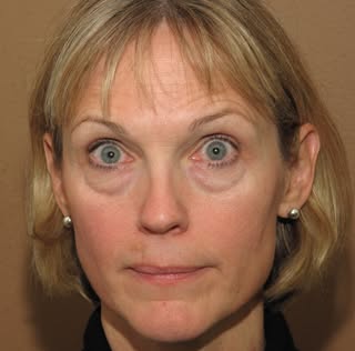 #bethebestyou 
Combination of #lowereyelidblepharoplasty and #fattransfersurgery 
Good news eyelid b