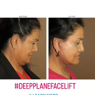 Complex facial rejuvenation combination of brow lift, eyelid lift midface deeplane lift, lower facel