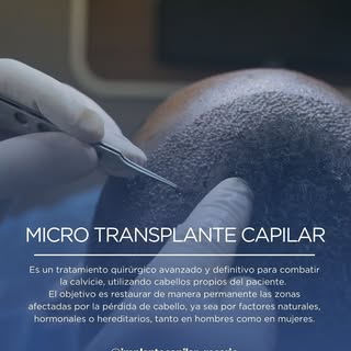 ¿Sufrís de pérdida de cabello y buscas una solución definitiva? El microimplante capilar es el trata