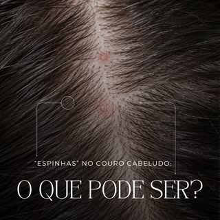 Nem toda “espinha” no couro cabeludo é acne. 👀

Aquelas bolinhas que coçam, doem ou ficam avermelha
