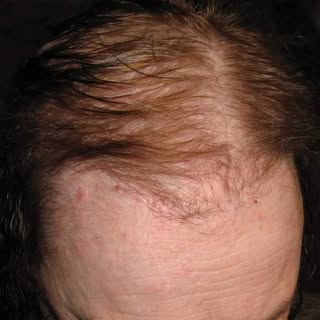 Nous avons la solution pour votre perte de cheveux.
www.cheveuxpourlavie.com