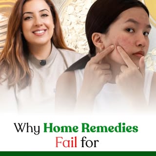 Teen acne is not just about pimples — it’s deeply connected to hormonal changes, lifestyle habits, a