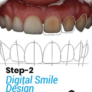 ✨ Transform Your Smile with Digital Smile Designing! ✨

A confident smile starts with the right plan