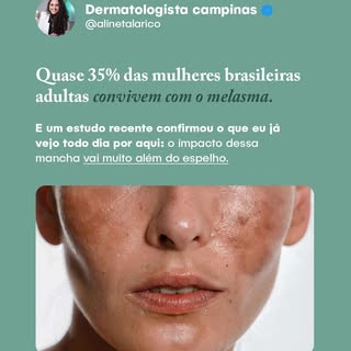 O melasma pode não ter uma cura definitiva, mas quando a gente associa a tecnologia certa na clínica