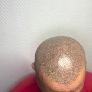 Effet rasé sur alopécie Norwood 7
👉🏼 Technique exclusive effet granuleux
👉🏼 Densité visuelle opt
