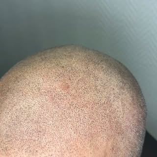 Voici à quoi ressemble une première séance de tricopigmentation effet rasé ✍🏽

Cette étape permet d