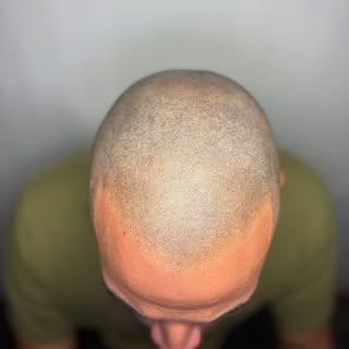 Effet rasé, golfes frontaux récupérés et zéro filtres
👉🏼 Swipe jusqu’à la dernière photo pour voir