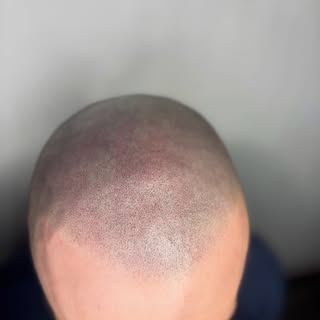 La Tricopigmentation, c’est l’art de redessiner l’invisible.

Une discipline où chaque point compte,