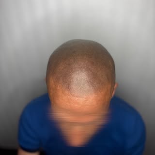 🇫🇷
Mon client a gagné des années… en en perdant visuellement.

Tricopigmentation effet rasé, le ré