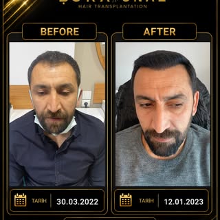 4100 Greft | Before & After

Her hastanın saç yapısı, dökülme tipi ve donör kapasitesi birbirinden f