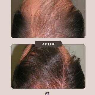 Patience wins when it comes to hair regrowth. 🌱

New growth isn’t always visible in the early month