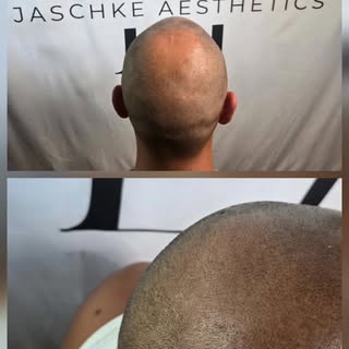 ✨ Session 2 von mindestens 4 ✨

▫️Nicht jeder entscheidet sich für eine Kopfhautpigmentierung nur au