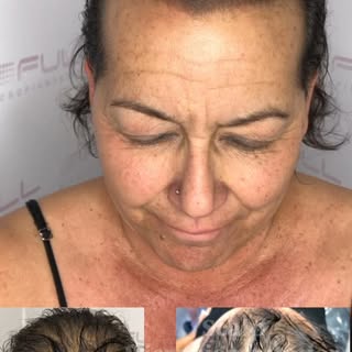 Female Density Treatment looking much FULLER after 3 sessions. 🖋️👩🏻

#fullmicro #scalpmicropigmen