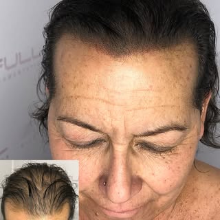 Still here changing lives 🖋️👩🏻🦾
 
#fullmicro #scalpmicropigmentation #hairtattoo #womenshair