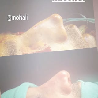 #rhinoplasty #nosejob #drrishidhawan #merakiplasticsurgery #maxhospitalmohali🏥💊🚑 nose deviation b
