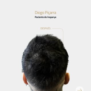 Los resultados son visibles desde el primer momento.

La micropigmentación capilar recrea visualment