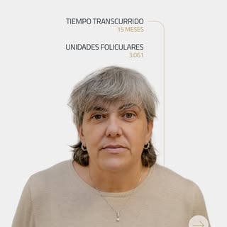 Trasplante capilar para mujeres con la tecnología BotHair UltraPlus®.

Cada unidad folicular se trat