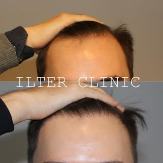 Patient som önskar sänka hårfästet en aning samt fylla i vikar. 1200 grafts placerade. Naturligt och