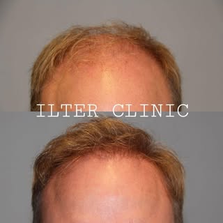 Fint resultat på en patient där vi återskapat hårfästet med 2000 hårsäcksgrupper. Fint, naturligt oc