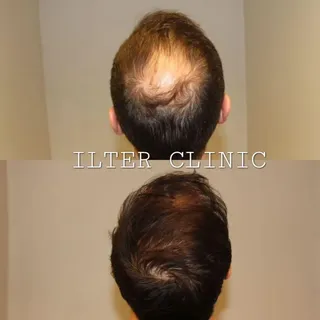 2000 hårsäcksgrupper placerade 💫 #hårtransplantation #hair #hairtransplant #håravfall #stockholm