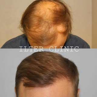 2000 hårsäcksgrupper placerade på fronten, naturligt och fint resultat. ✨ #har #hårtransplantation #