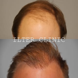 Här har vi placerat 2000 hårsäckar på fronten, patienten har fått ett naturligt resultat och är väld