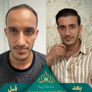 حسین یوسفی نژاد👇👇👇
.
موهای نازک و کم پشت در ناحیه خط رویش و شقیقه‌ها
.
وارد پیج بشید و نمونه‌ کار