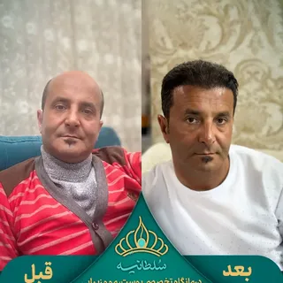 سطح طاسی بسیار بالا👇👇
.
.
سطح طاسی بسیار بالا و یک نتیجه فوق‌العاده. نتیجه‌ای که فقط توی کلینیک سل