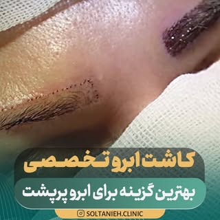 ✨ ابروهایی که همیشه آرزوشون رو داشتید، حالا می‌تونن واقعی باشن!

اگر از کم‌پشتی یا ریزش ابروهاتون خس