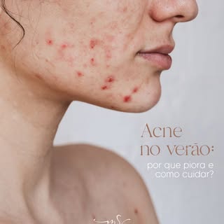 No verão, é comum a acne piorar por causa do calor, do suor e do uso de produtos inadequados para o 