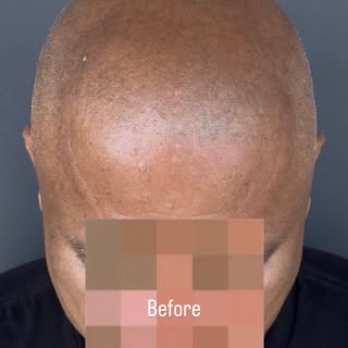 SWIPE LEFT FOR AFTER FIRST SESSION RESULTS:

The transformation you see here is after just the first