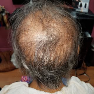 Angrogenic Alopecia. Bonded a polyurethane based hair unit to achieve this look