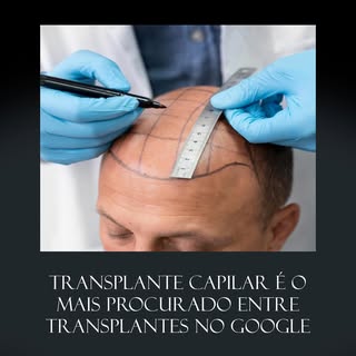 Nos últimos anos, a procura pelo transplante capilar cresceu muito. A intensificação se deve à consc