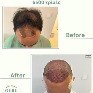 Before ➡️ After | Αμέσως μετά το χειρουργείο
 
Η αλλαγή ξεκινά από την πρώτη κιόλας ημέρα!

2.500 μο
