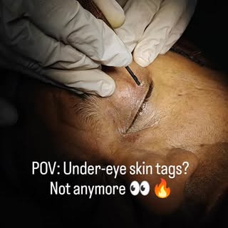 POV: You finally removed those tiny under-eye skin tags 👀✨

And now your skin looks smooth, clean &
