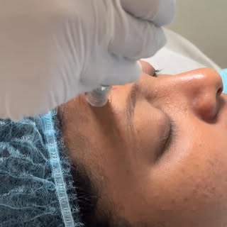 Ready to hit the reset button on your skin? ✨
Our Microneedling + Exosome infusion is the ultimate p