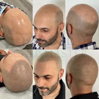 Before SMP and HEALED RESULTS 💯 showcasing different angles of hair loss and how it has improved 10