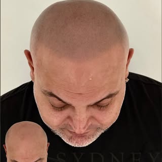Your hairline is calling… are you ready to answer? ☎️✨

At Sydney Scalp Master, our Scalp Micropigme