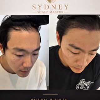 Thinning hair doesn’t have to define your look—or your confidence.

At Sydney Scalp Master, our adva
