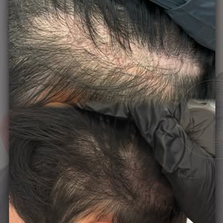 Thinning hair doesn’t have to define your confidence.💯

At Sydney Scalp Master, we create the illus