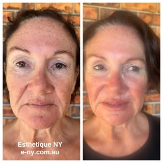 Full face rejuvenation with Di at Esthetique NY.  Individual results may vary. All cosmetic treatmen