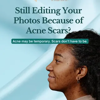 Still editing your photos because of acne scars?

Acne may fade, but scars can stay for years when n